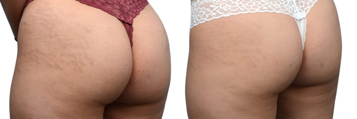 VBeam® Before & After Gallery - Patient 316299 - Image 3
