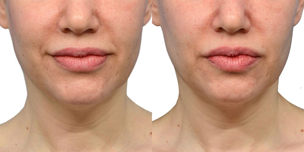 Ultherapy before and after
