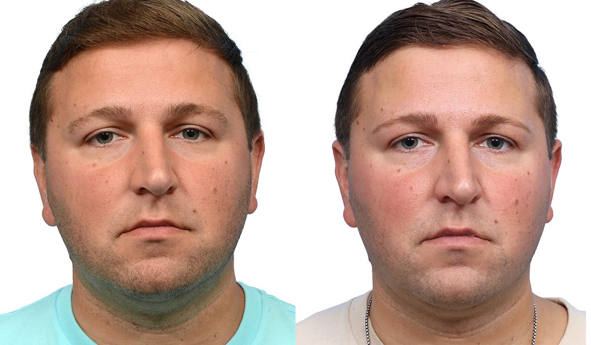 Ultherapy before and after