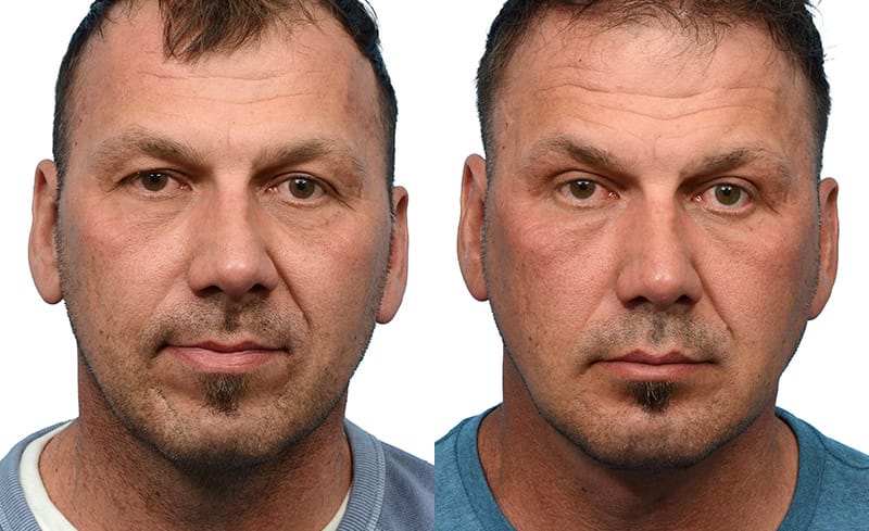 Submentoplasty Before & After Gallery - Patient 192180 - Image 1