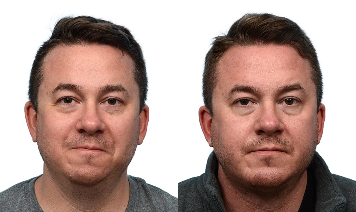 Submental Liposuction Before & After Gallery - Patient 196514 - Image 2