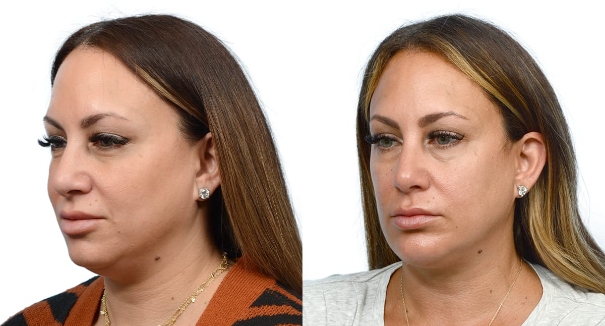 Submental Liposuction Before & After Gallery - Patient 247330 - Image 3