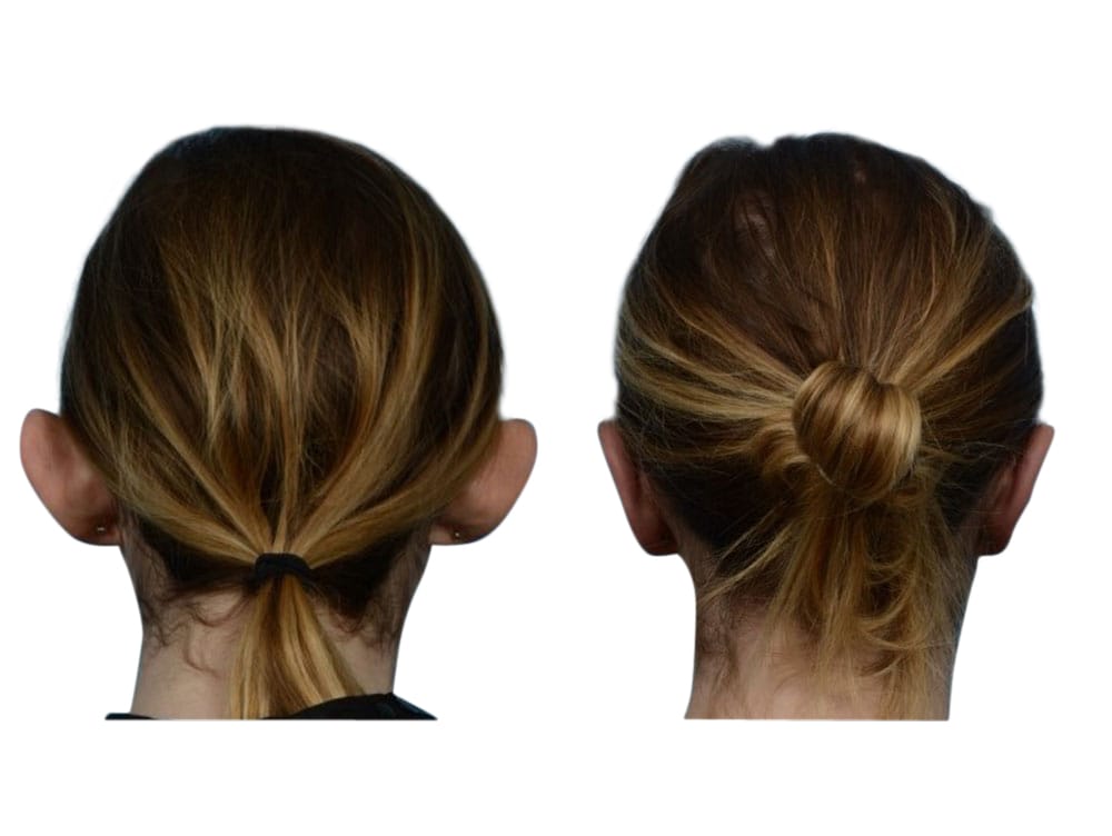 Otoplasty (Ear Surgery) Before & After Gallery - Patient 150040 - Image 2