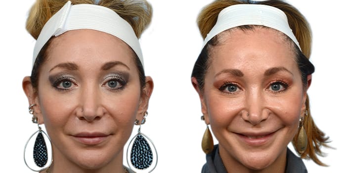 Otoplasty (Ear Surgery) Before & After Gallery - Patient 149988 - Image 1