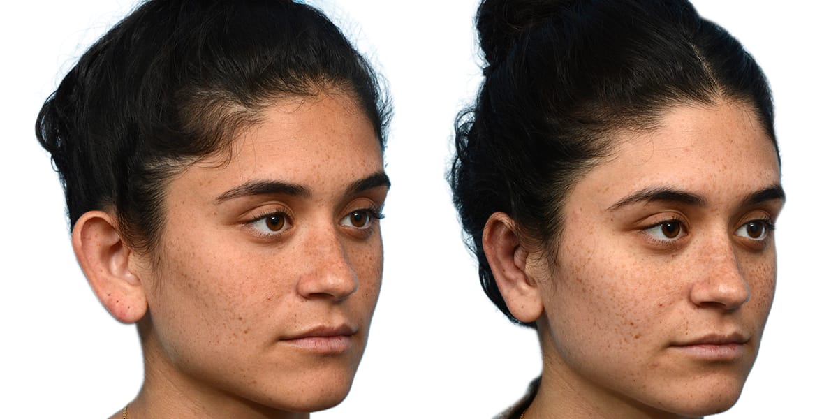 Otoplasty (Ear Surgery) Before & After Gallery - Patient 597596 - Image 4