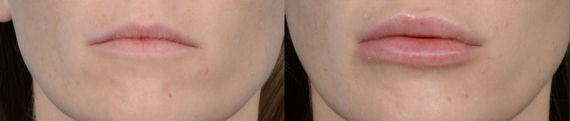 Lip Enhancement Before & After Gallery - Patient 994424 - Image 1