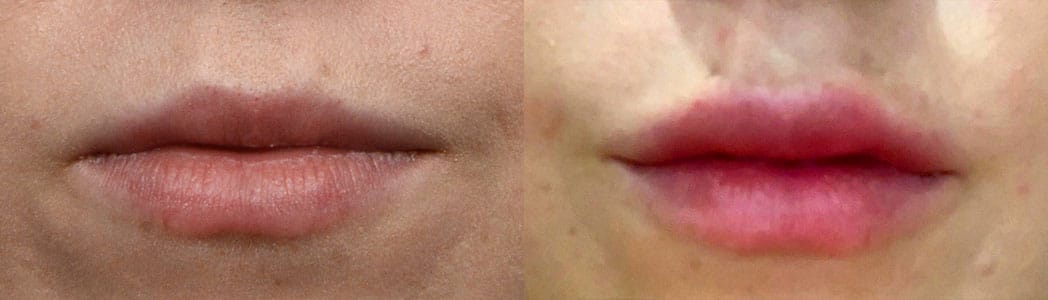 Lip Enhancement Before & After Gallery - Patient 251630 - Image 1