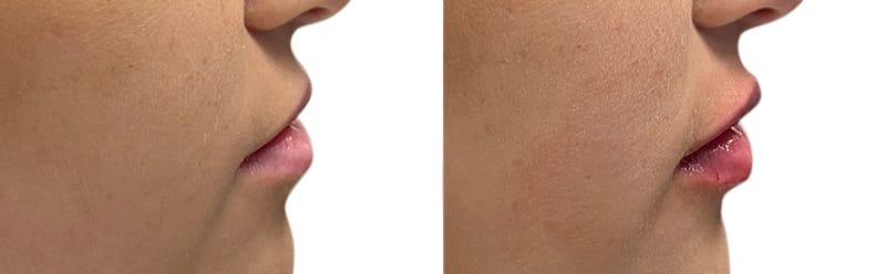 Lip Enhancement Before & After Gallery - Patient 248473 - Image 3