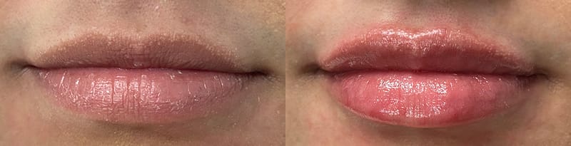 Lip Enhancement Before & After Gallery - Patient 843519 - Image 1
