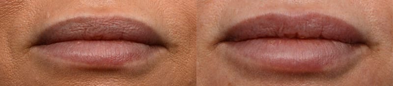 Lip Enhancement Before & After Gallery - Patient 262341 - Image 1