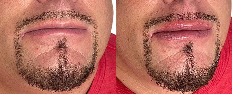 Lip Enhancement Before & After Gallery - Patient 366048 - Image 1