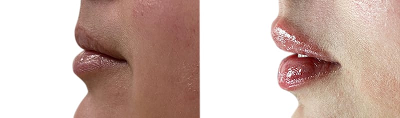 Lip Enhancement Before & After Gallery - Patient 280493 - Image 3
