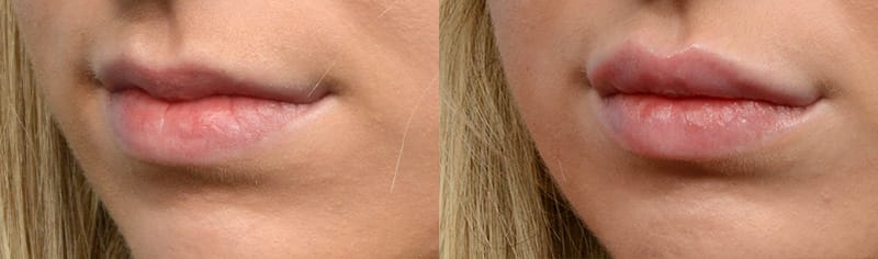Lip Enhancement Before & After Gallery - Patient 425850 - Image 3
