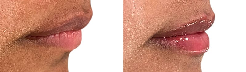 Lip Enhancement Before & After Gallery - Patient 114829 - Image 2