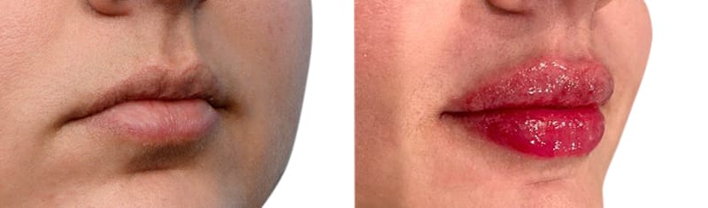 Lip Enhancement Before & After Gallery - Patient 227171 - Image 2