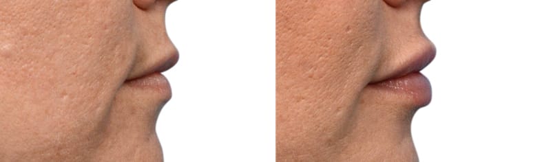 Lip Enhancement Before & After Gallery - Patient 334358 - Image 4