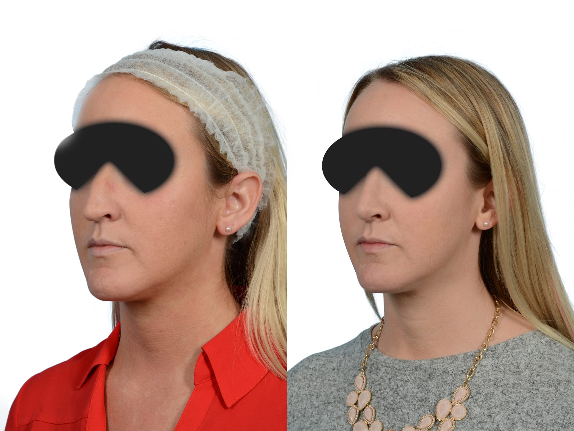 Rhinoplasty Before & After Gallery - Patient 167212 - Image 4
