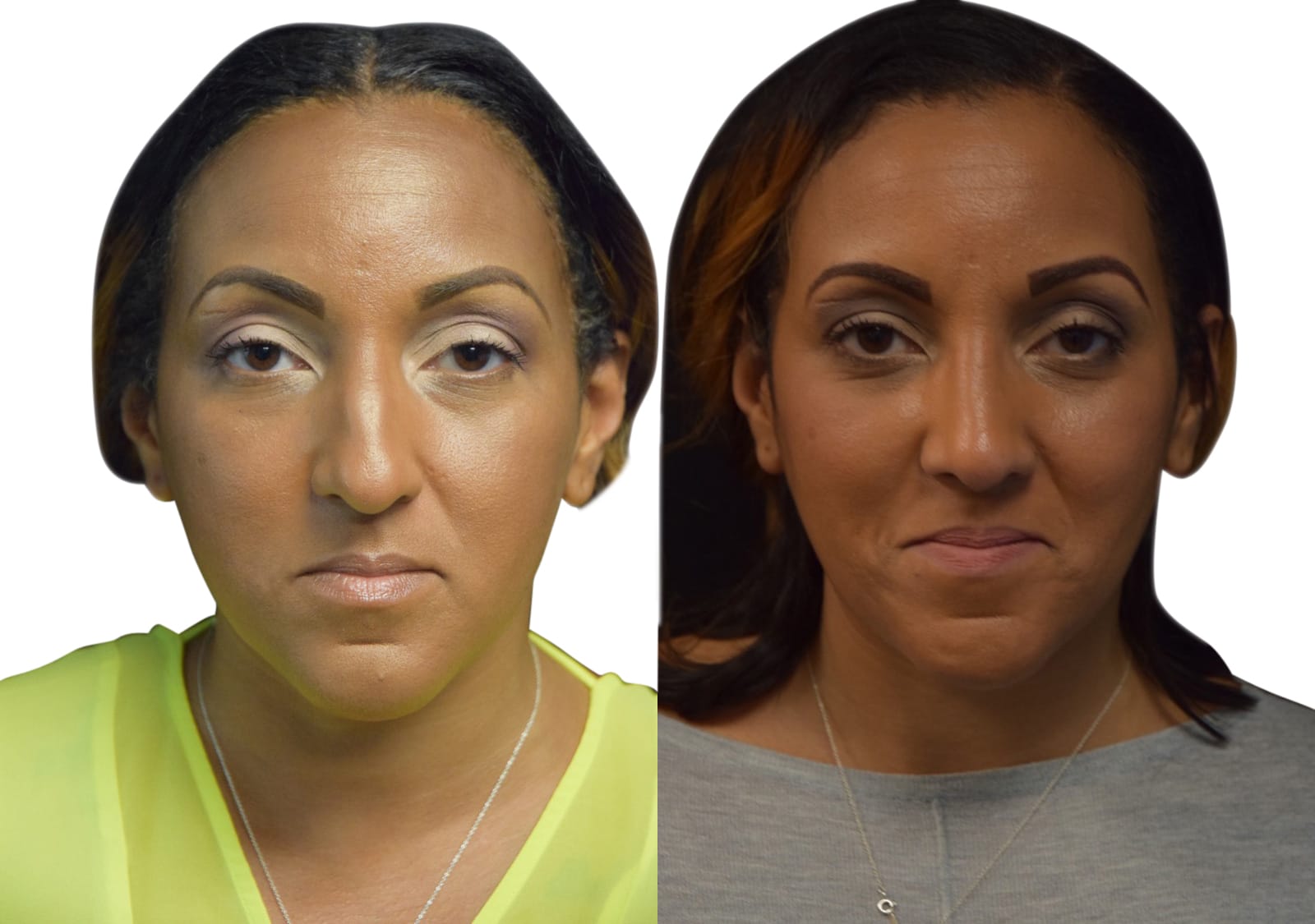 Rhinoplasty Before & After Gallery - Patient 283475 - Image 4