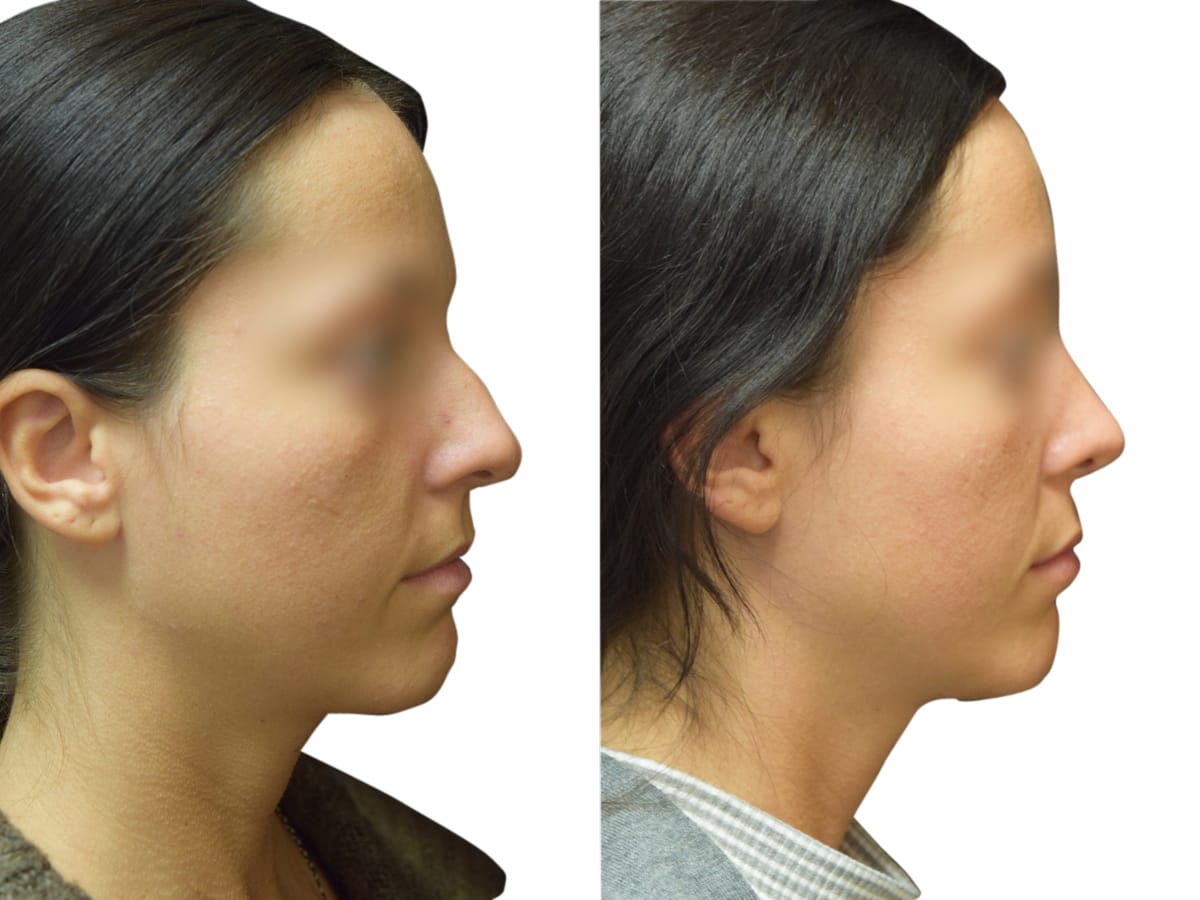 Rhinoplasty Before & After Gallery - Patient 383933 - Image 1
