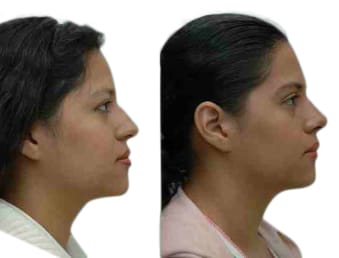 Rhinoplasty Before & After Gallery - Patient 156452 - Image 1