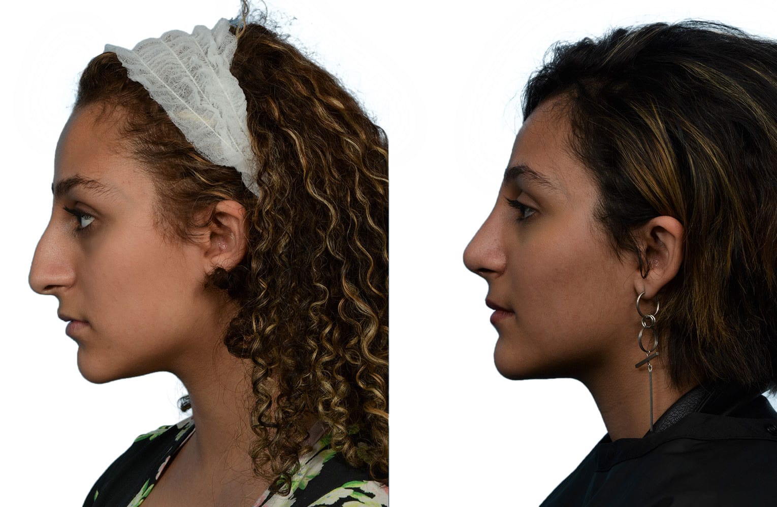 Rhinoplasty Before & After Gallery - Patient 222180 - Image 1