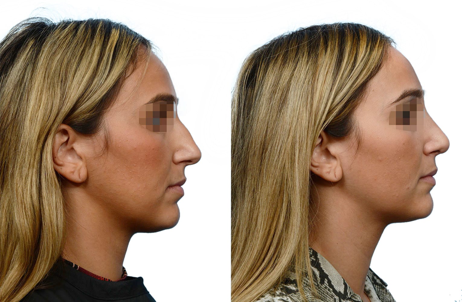 Rhinoplasty Before & After Gallery - Patient 414787 - Image 1