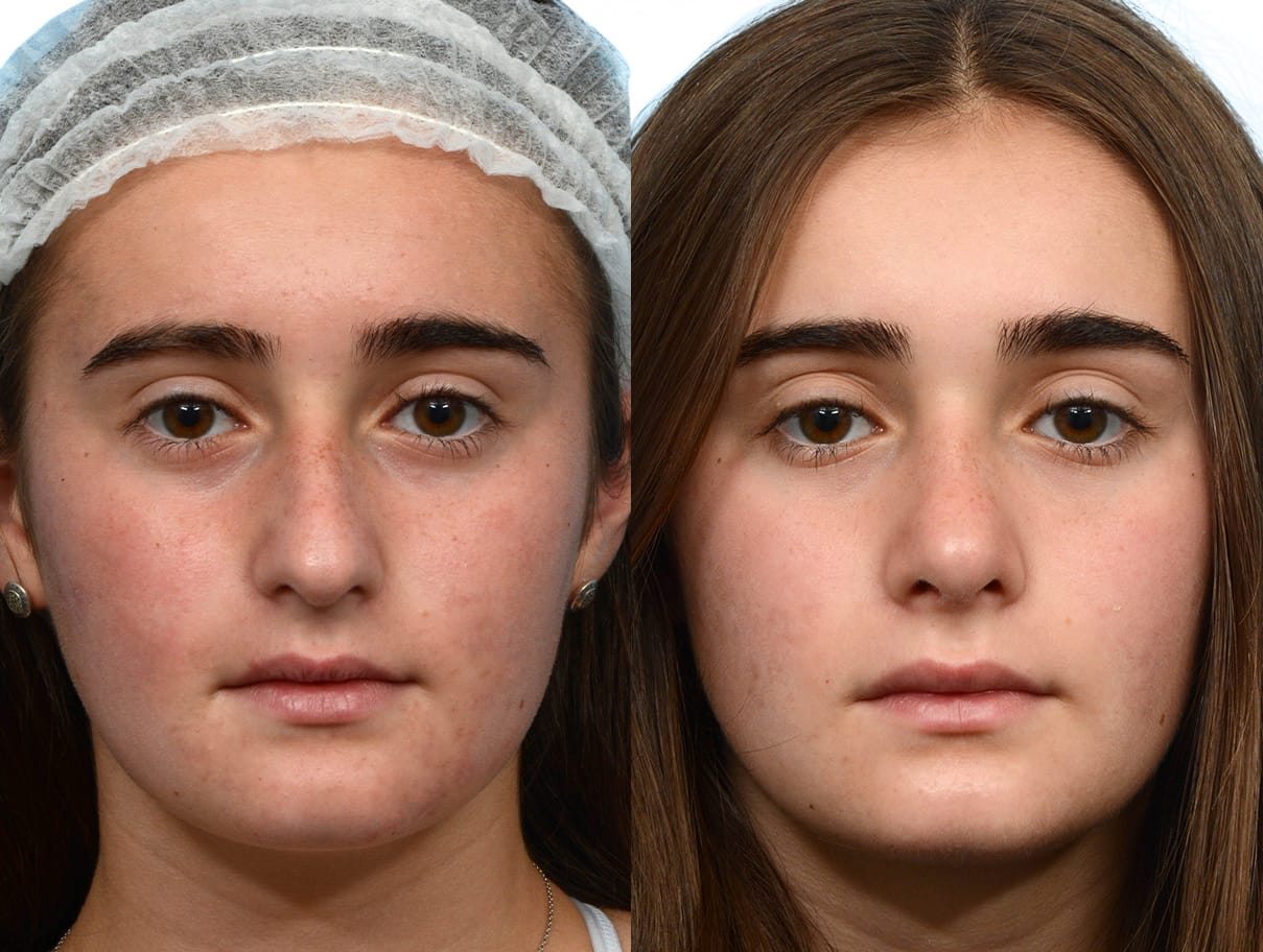 Rhinoplasty Before & After Gallery - Patient 211861 - Image 3