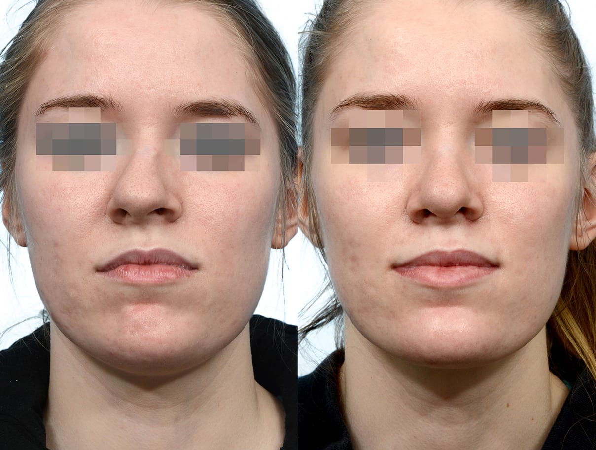 Rhinoplasty Before & After Gallery - Patient 101879 - Image 3