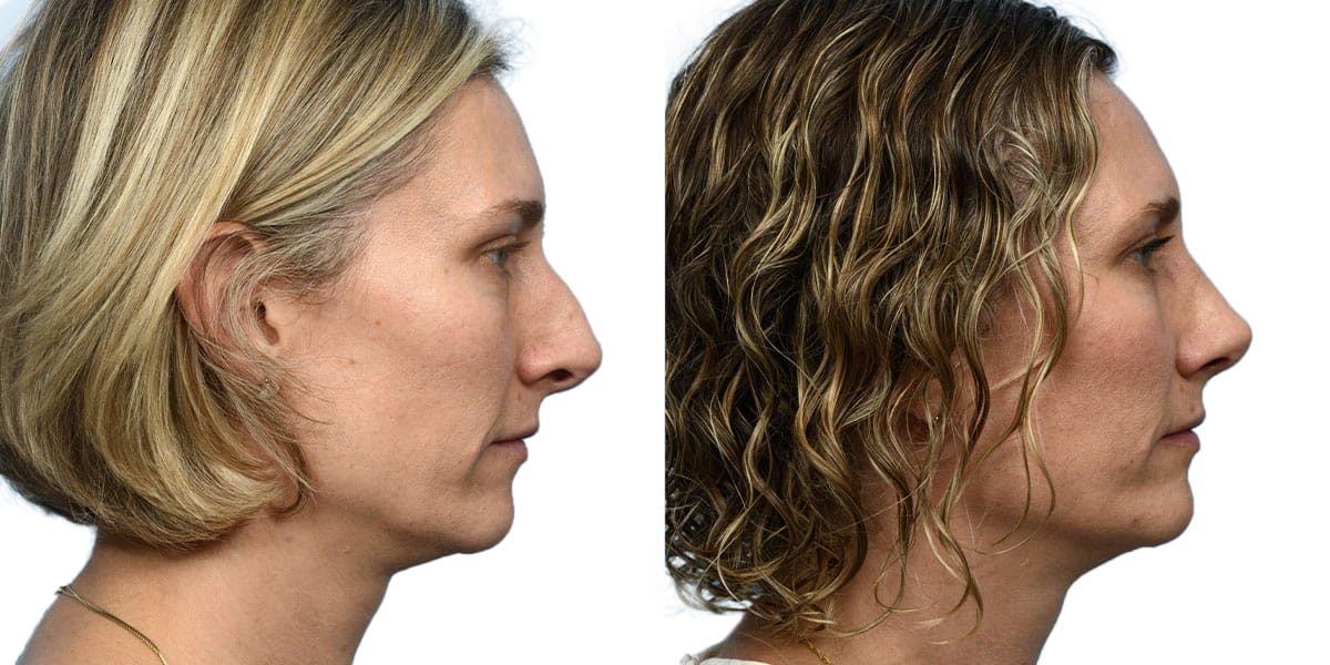 Rhinoplasty Before & After Gallery - Patient 335192 - Image 1