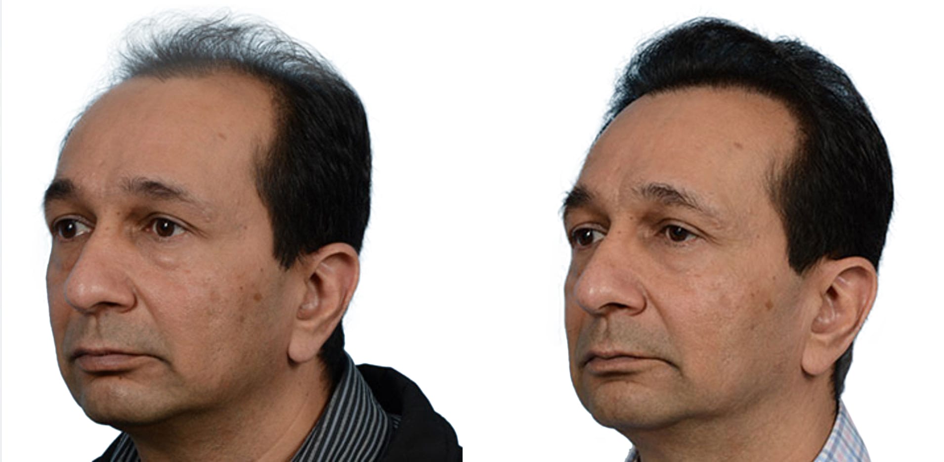 FUE Hair Transplant Before & After Gallery - Patient 229964 - Image 3