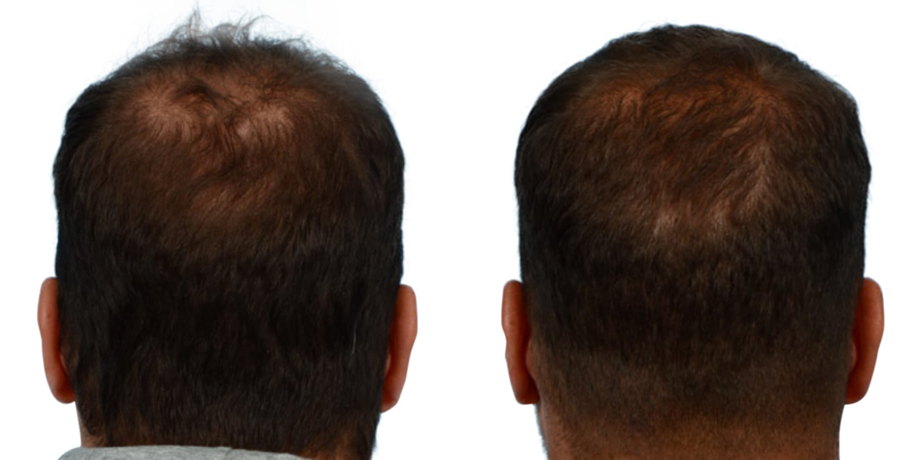 FUE Hair Transplant Before & After Gallery - Patient 370280 - Image 2
