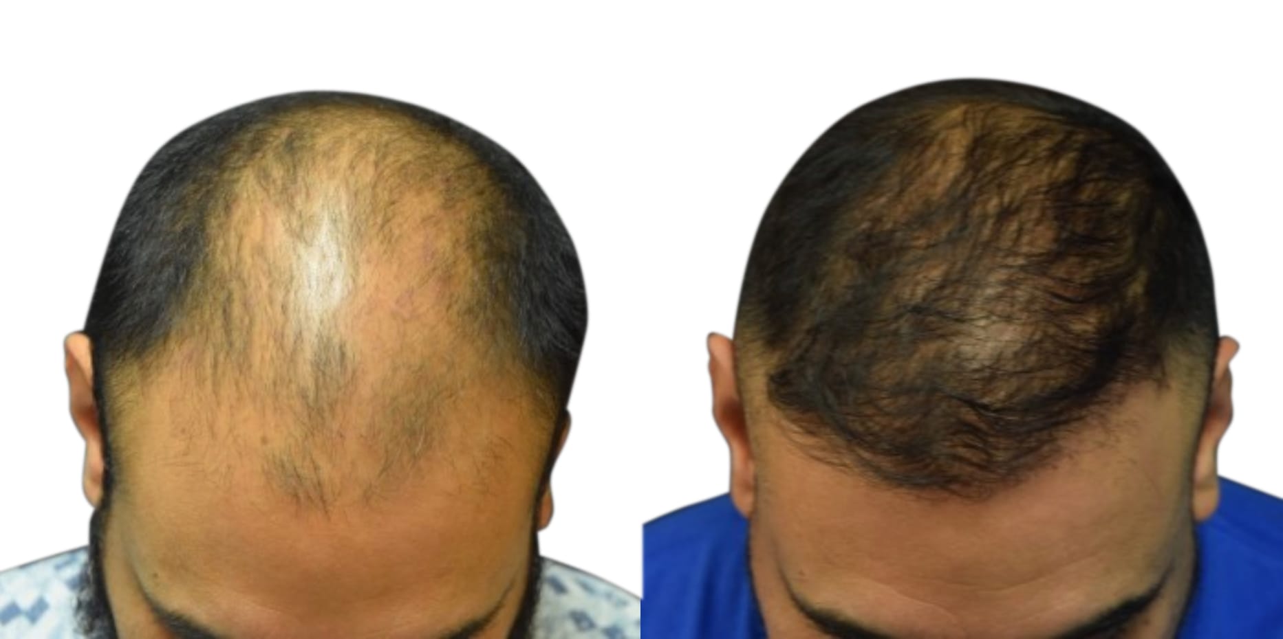 FUE Hair Transplant Before & After Gallery - Patient 714890 - Image 2