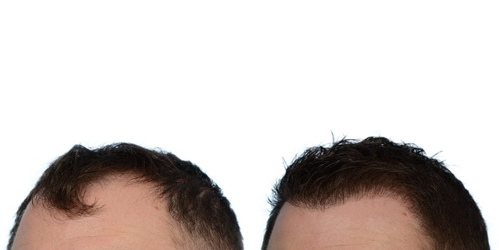 FUE Hair Transplant Before & After Gallery - Patient 422298 - Image 3