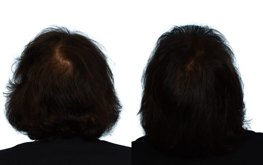 FUE Hair Transplant Before & After Gallery - Patient 201060 - Image 2
