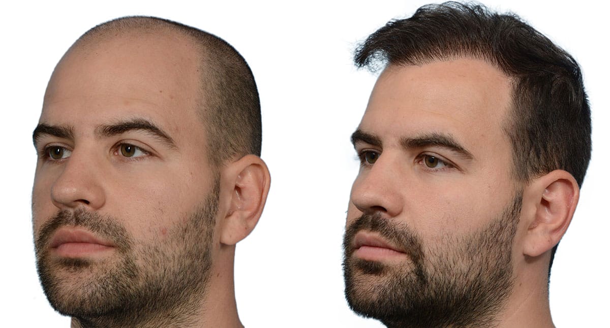 FUE Hair Transplant Before & After Gallery - Patient 348084 - Image 2