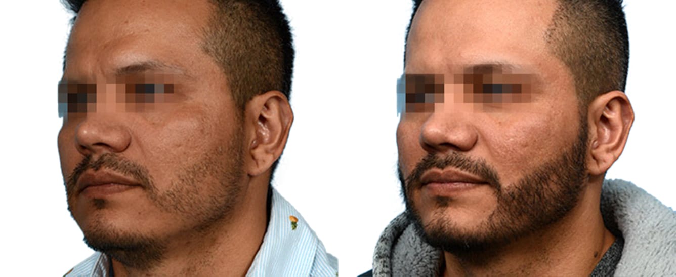 FUE Hair Transplant Before & After Gallery - Patient 144509 - Image 2