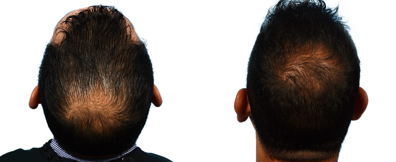 Hair Restoration  Before & After Gallery - Patient 114079 - Image 2