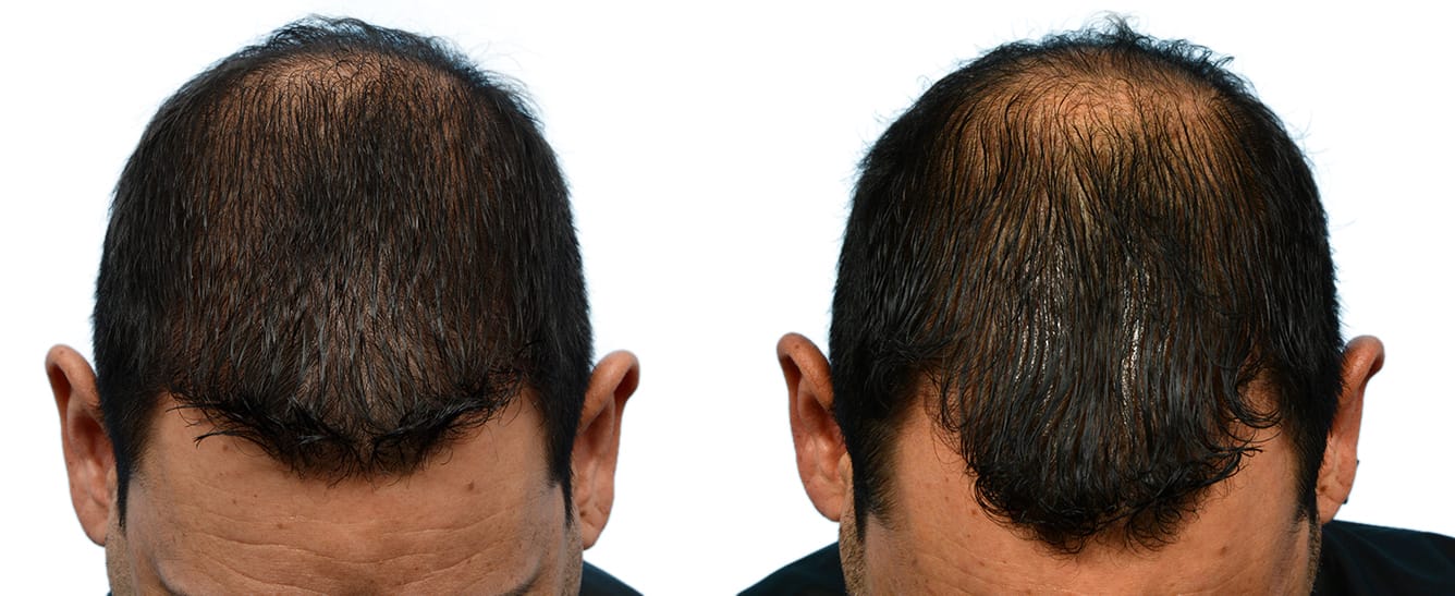 Hair Restoration  Before & After Gallery - Patient 114079 - Image 3