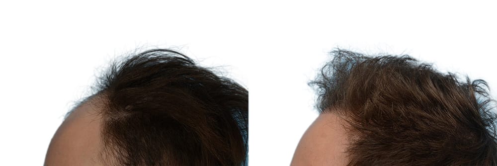 FUE Hair Transplant Before & After Gallery - Patient 117873 - Image 3