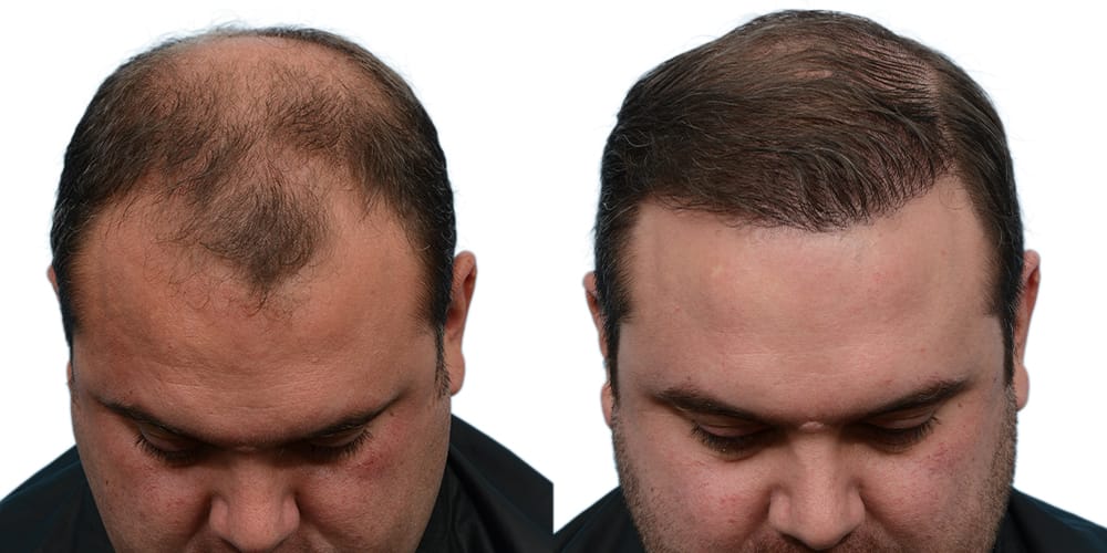 FUE Hair Transplant Before & After Gallery - Patient 256877 - Image 2