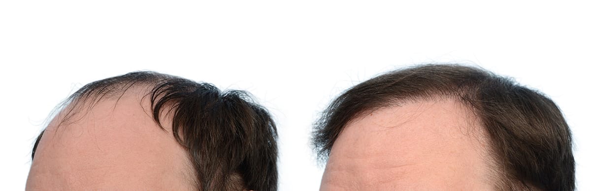 Hair Restoration Before & After Gallery - Patient 410592 - Image 3