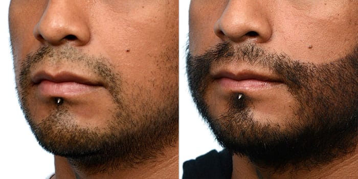 FUE Hair Transplant Before & After Gallery - Patient 352869 - Image 2