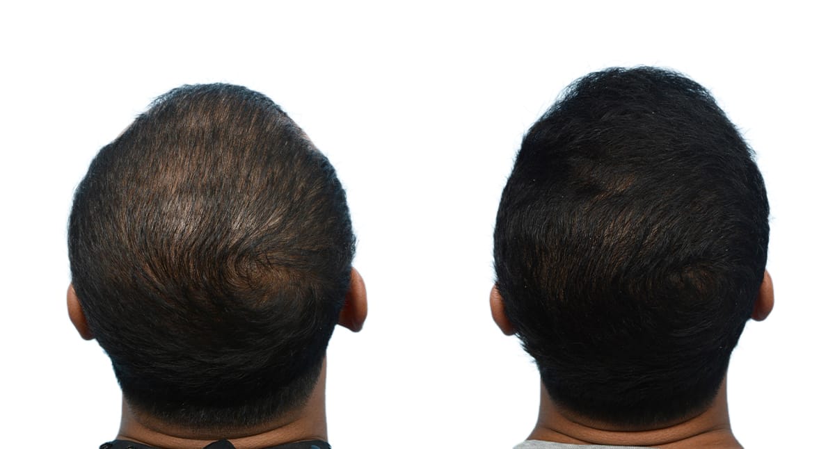 FUE Hair Transplant Before & After Gallery - Patient 919707 - Image 2