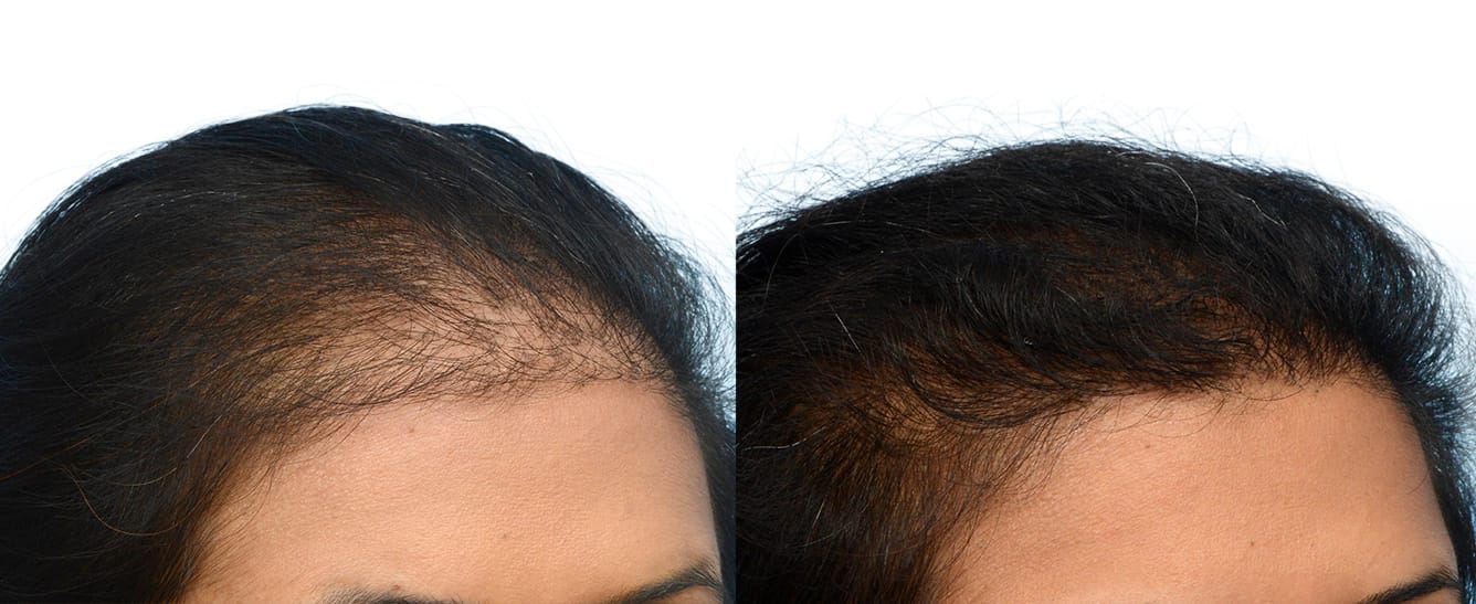 Hair Restoration  Before & After Gallery - Patient 515681 - Image 2