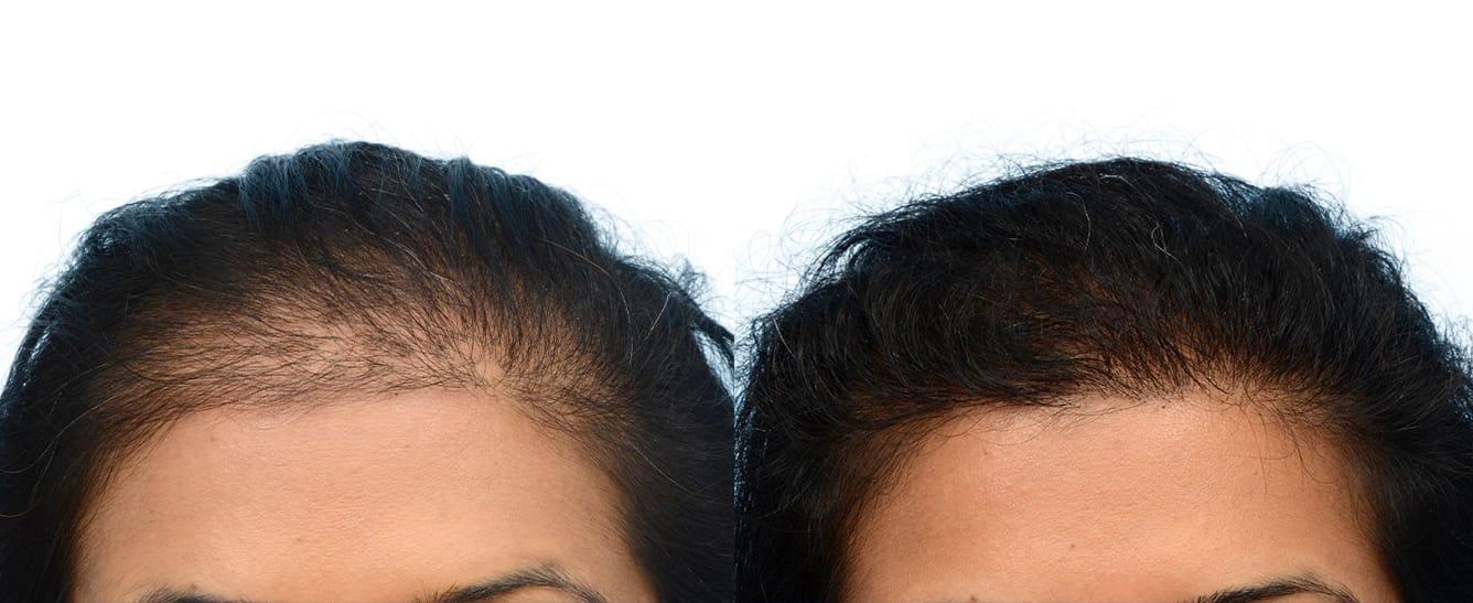 Hair Restoration  Before & After Gallery - Patient 515681 - Image 3