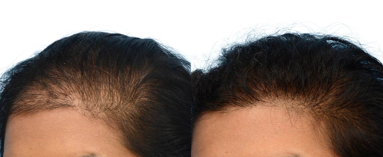 Hair Restoration  Before & After Gallery - Patient 515681 - Image 4