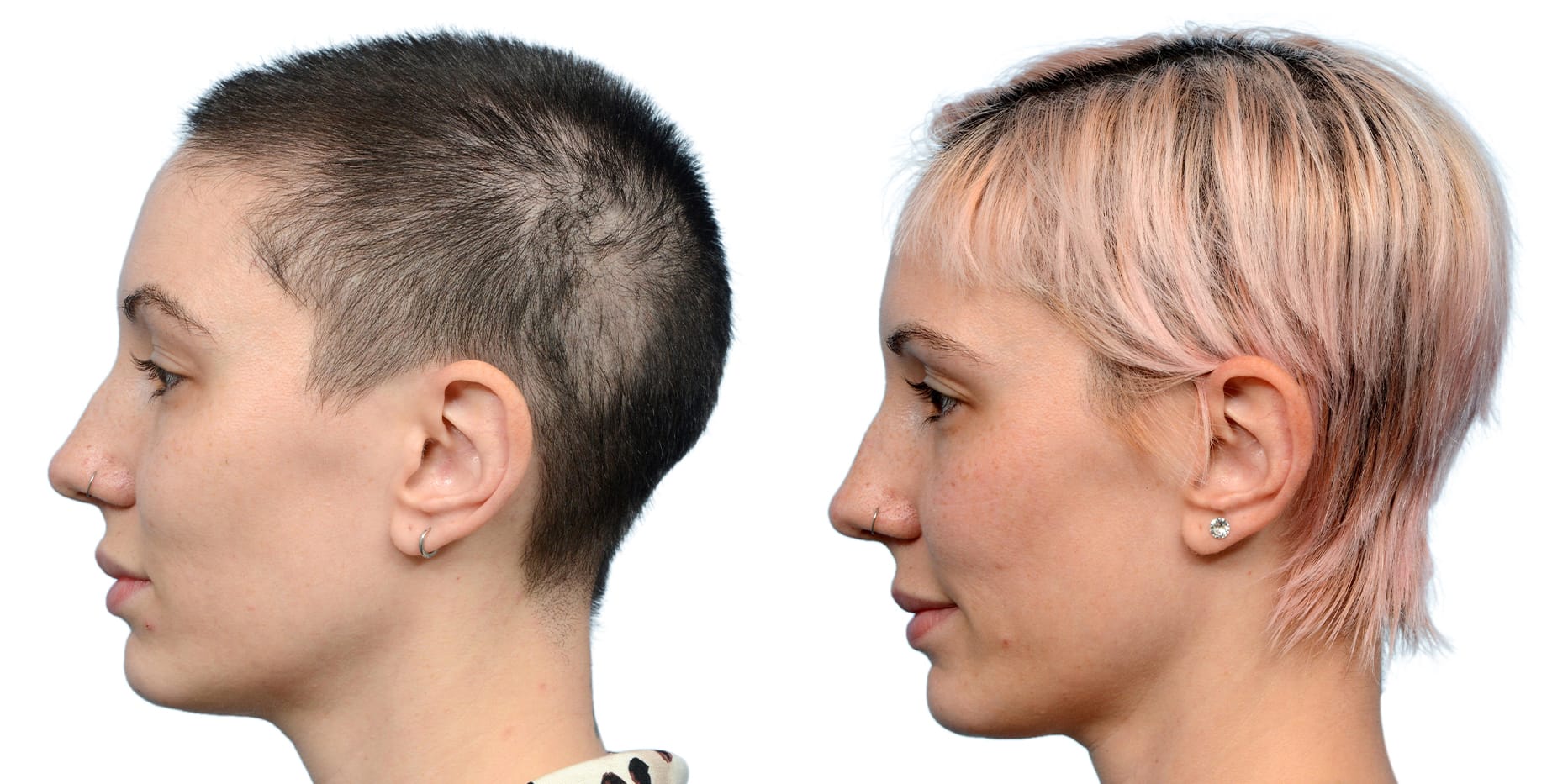 FUE Hair Transplant Before & After Gallery - Patient 559187 - Image 4