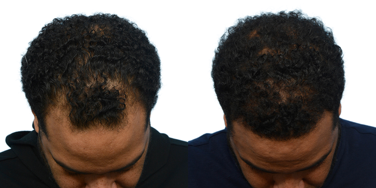 FUE Hair Transplant Before & After Gallery - Patient 373700 - Image 2