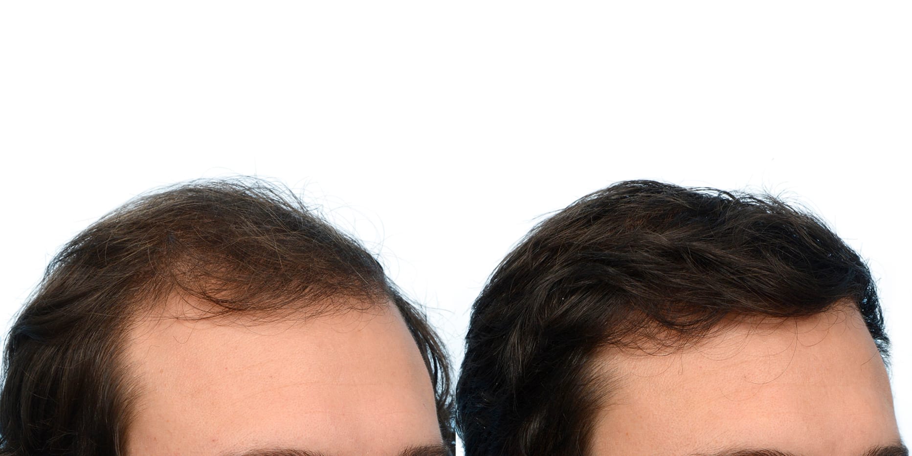 FUE Hair Transplant Before & After Gallery - Patient 248168 - Image 4