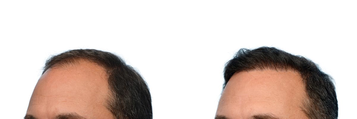 Hair Restoration  Before & After Gallery - Patient 304379 - Image 2
